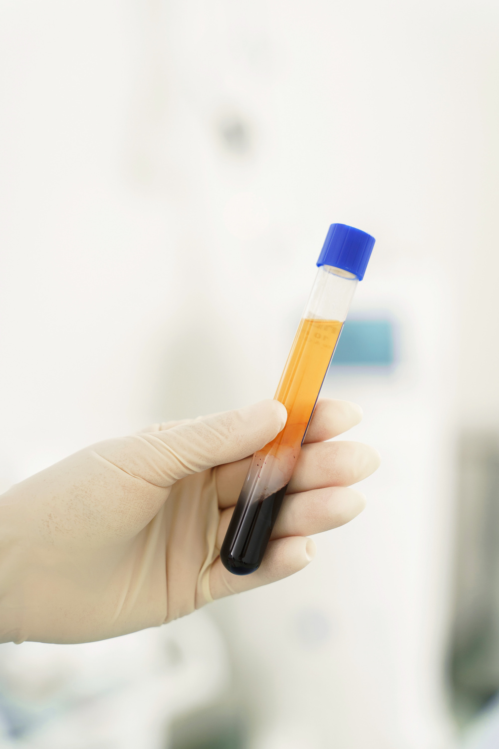 Vacutainer with a platelet-rich plasma and blood for PRP treatment